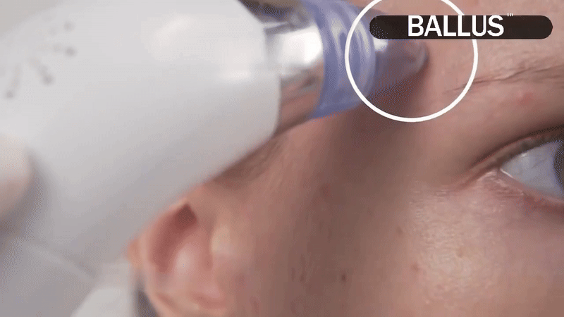 Pore Cleaning Device - easy blackheads cleaner